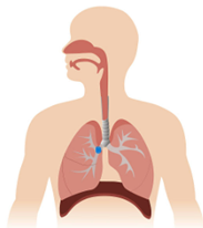 Diagrama de obstrucción total de las vías respiratorias 